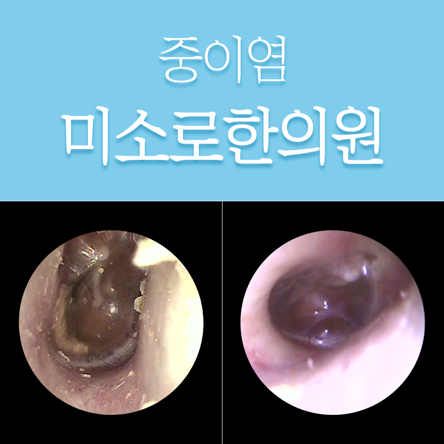 경기광주 중이염 열 관련 이미지