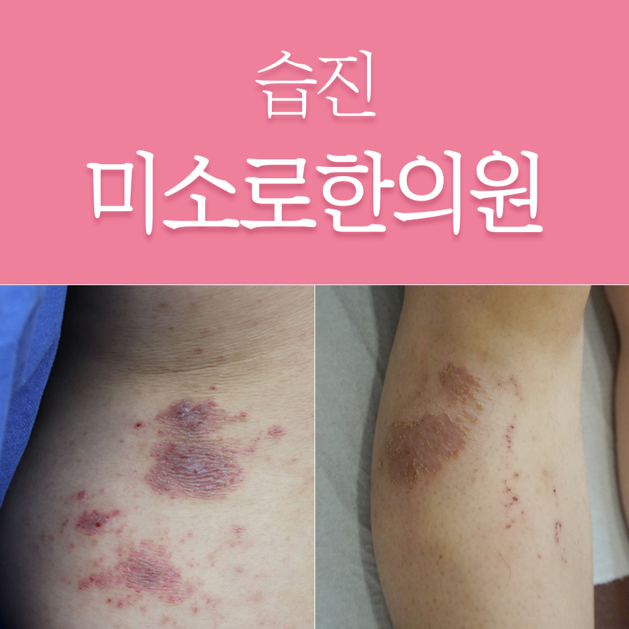 성남 엉덩이 습진 치료 관련 이미지