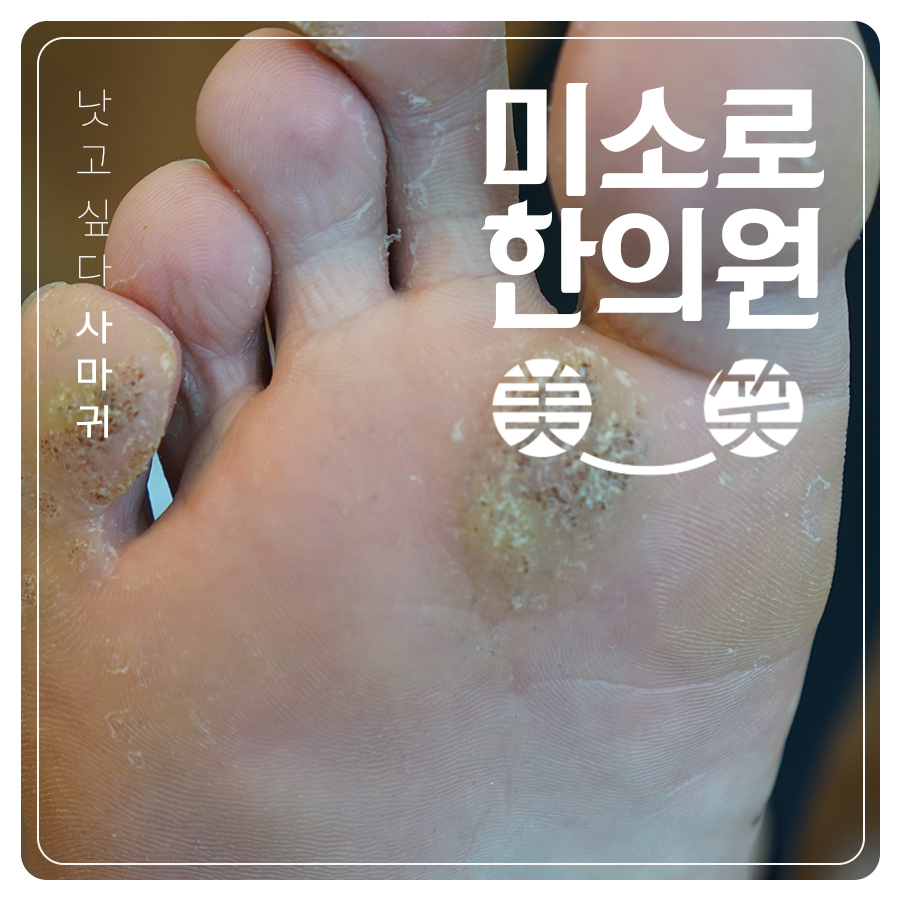 여주 편사마귀 원인 관련 이미지