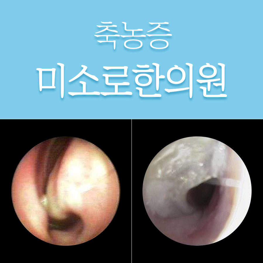 부천 만성 축농증 치료 방법 관련 이미지
