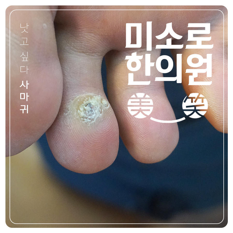 분당 사마귀한방치료 관련 이미지