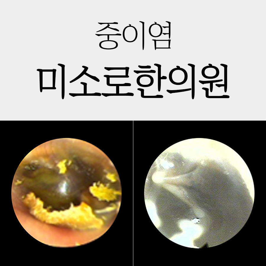 여주 중이염 치료기간 관련 이미지