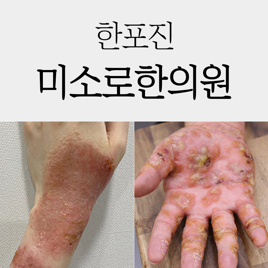 경기광주 발바닥 한포진 치료 병원 관련 이미지