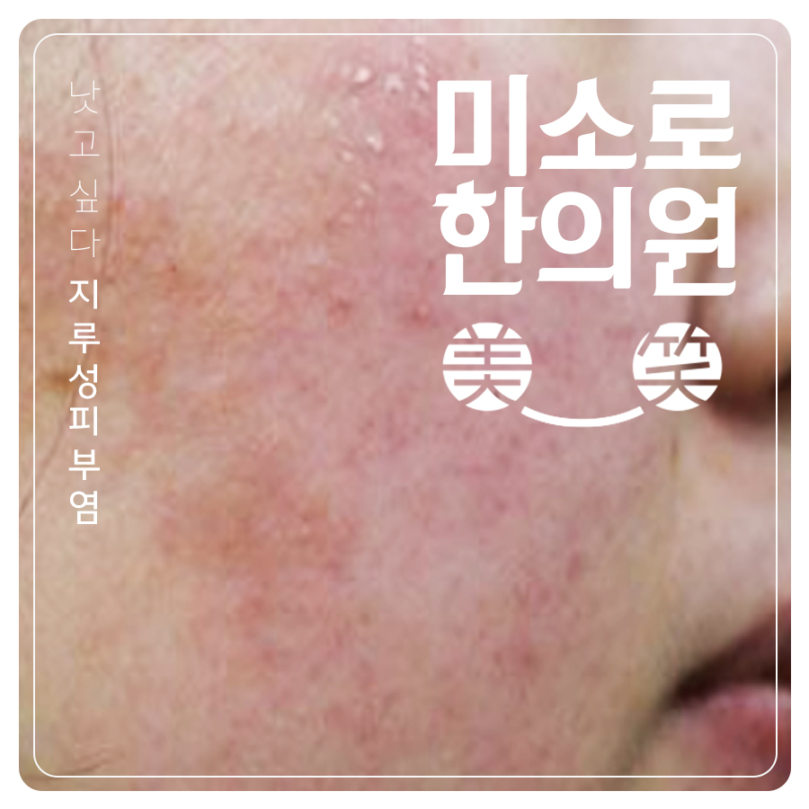 구월동 두피지루성피부염피부과 관련 이미지