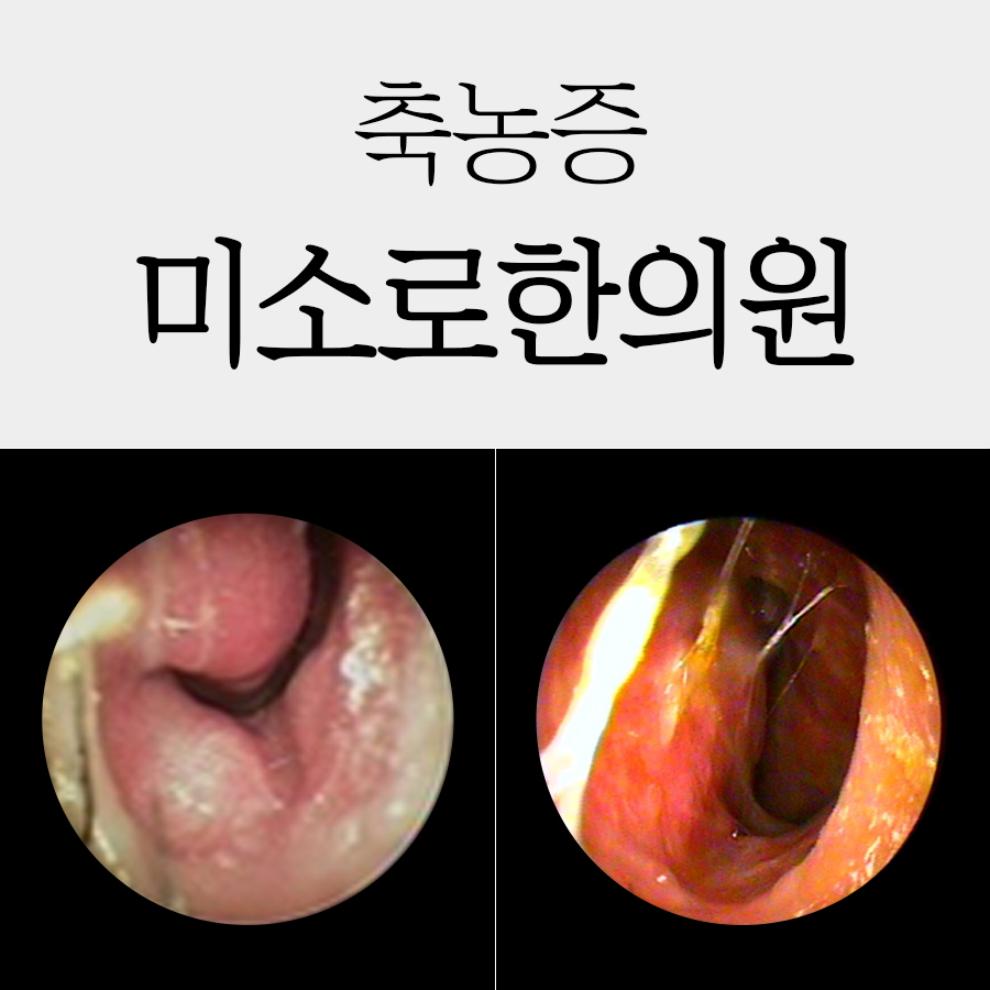 분당 축농증 이비인후과 관련 이미지