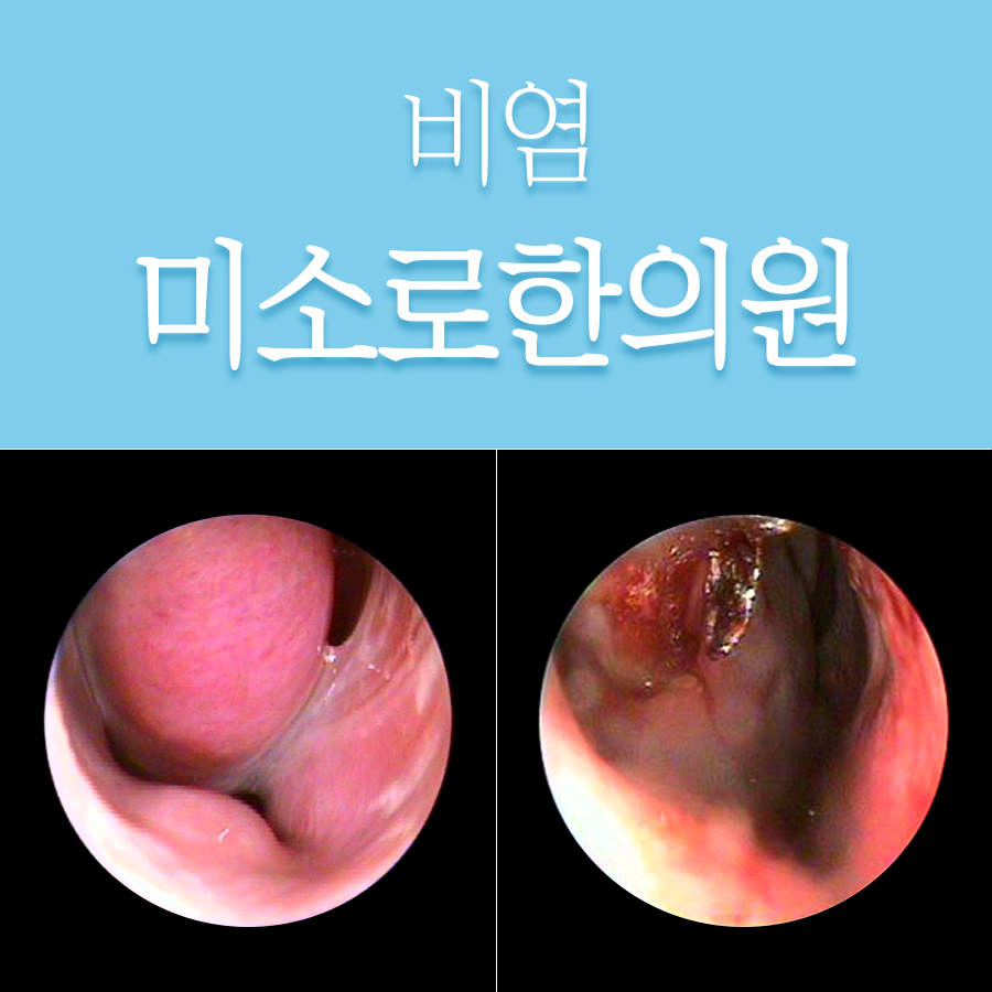 분당 소아알레르기비염 관련 이미지