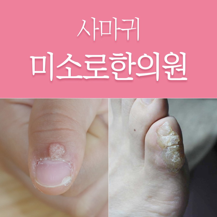 분당 한의원 사마귀 관련 이미지