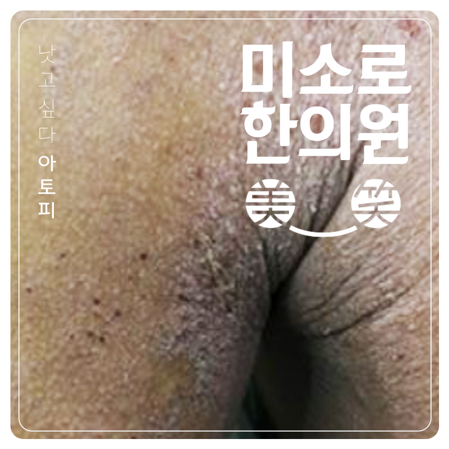 용인 성인아토피치료방법 관련 이미지