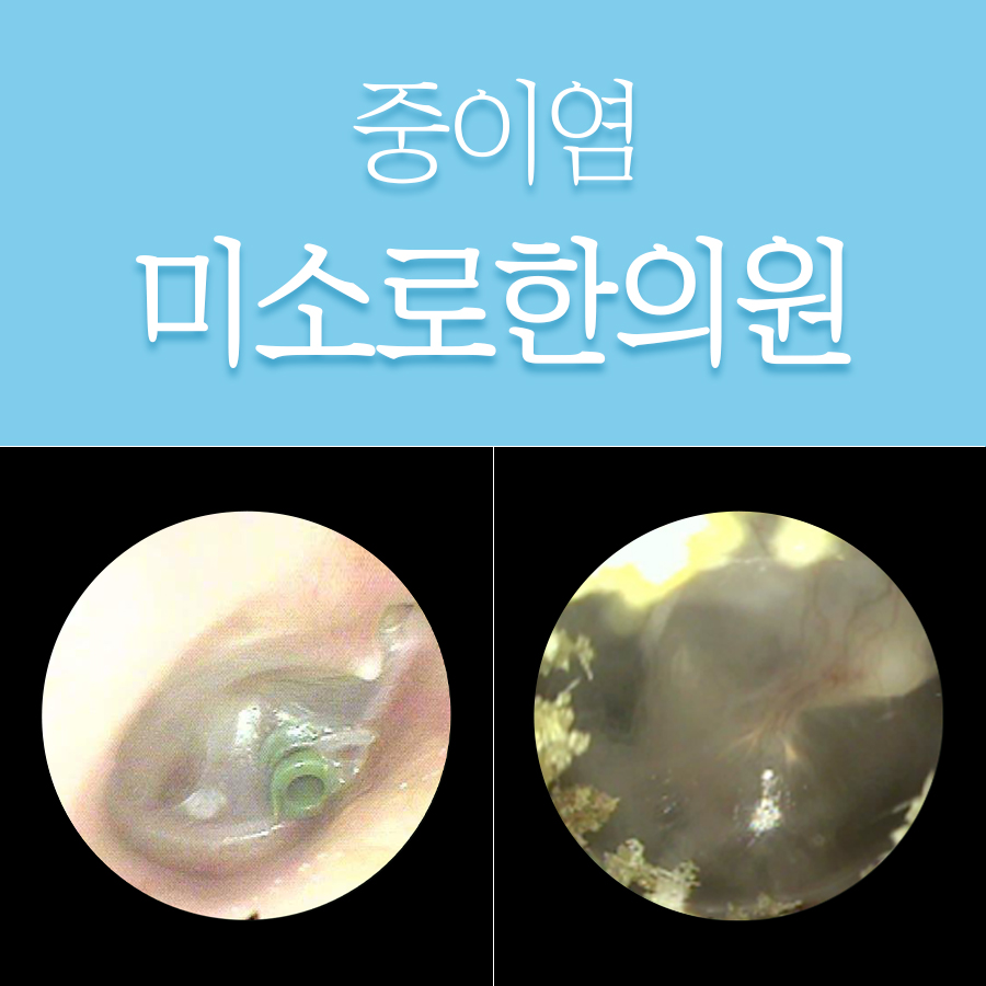 성남 삼출성 중이염 증상 관련 이미지