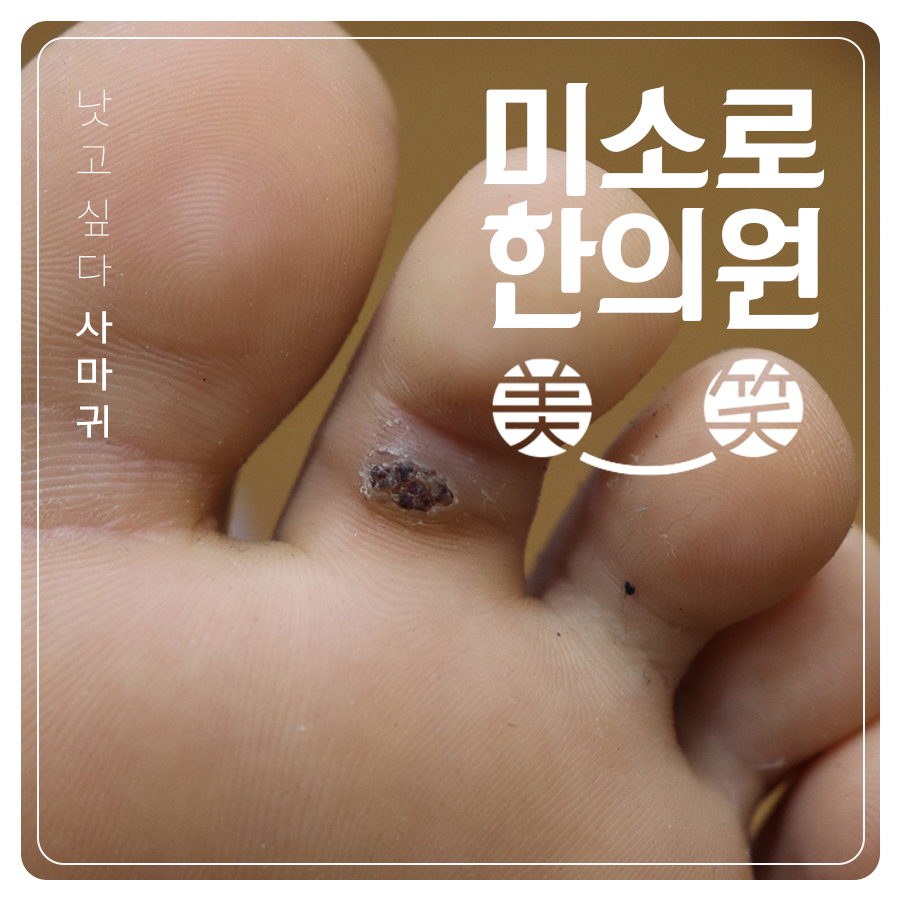 분당 족저사마귀한의원 관련 이미지