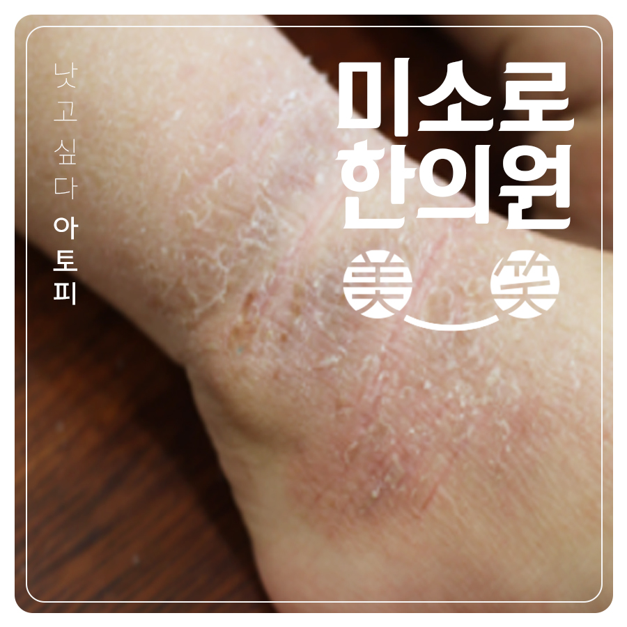 판교 다리 아토피 치료 방법 관련 이미지