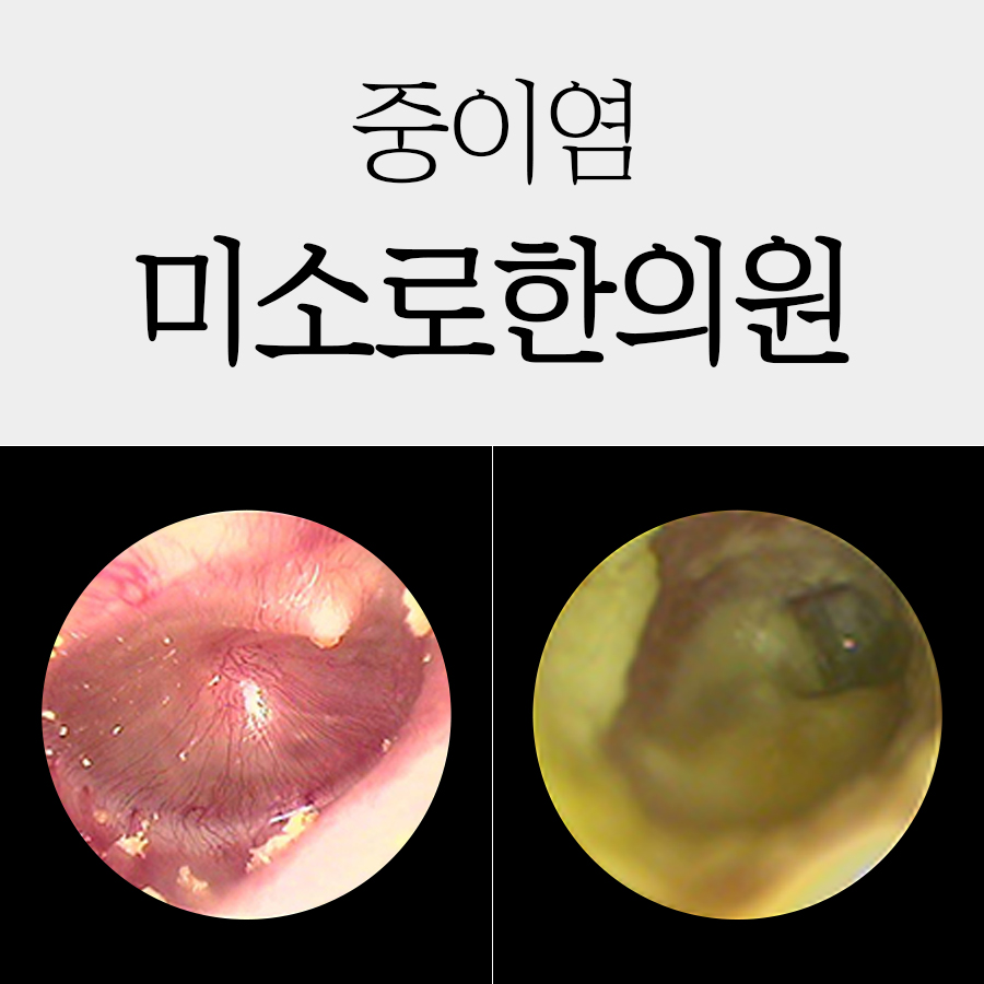 중이염 증상 관련 이미지