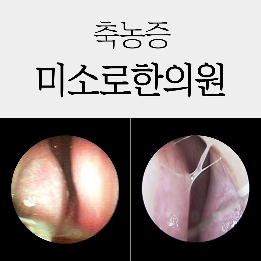 배방 진균성 부비동염 한의원 관련 이미지