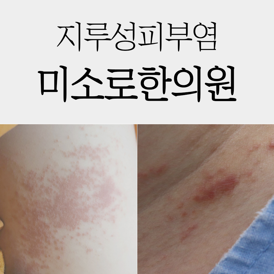위례 지루성피부염 원인 및 치료법 관련 이미지