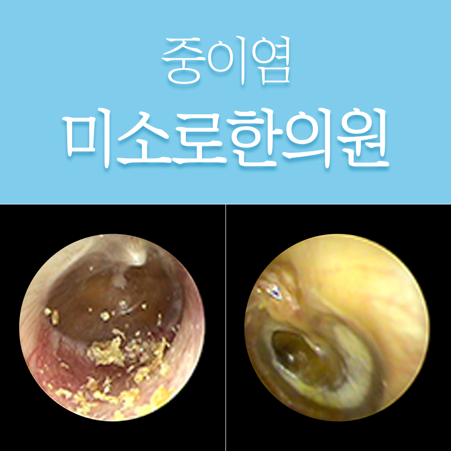 용인 삼출성 중이염 한의원 관련 이미지