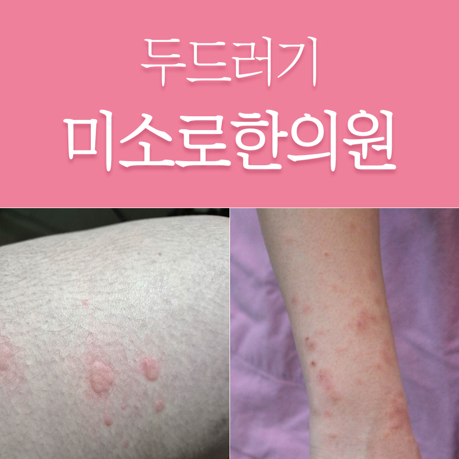 이천 콜린성 두드러기 한의원비용 관련 이미지