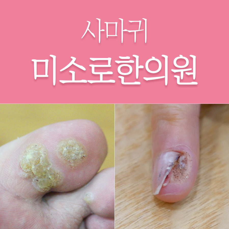 이천 편사마귀 연고 관련 이미지