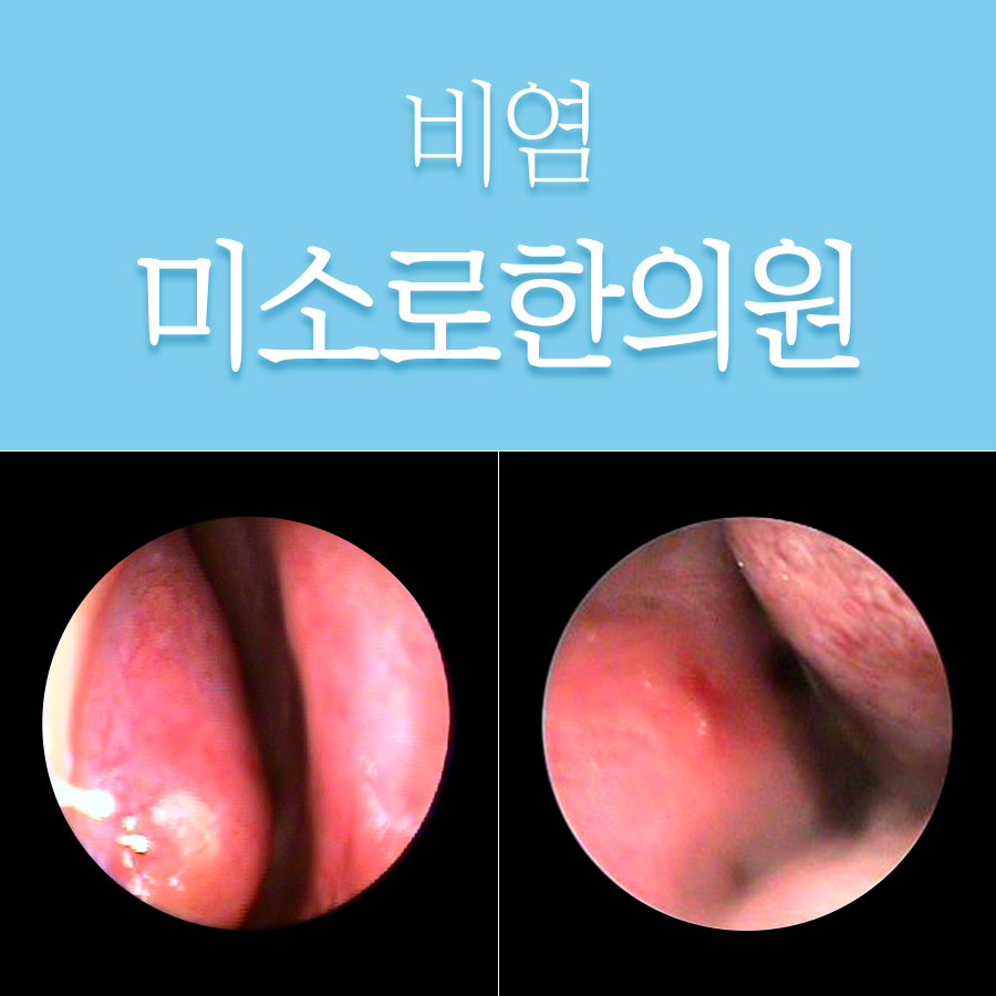 경기광주 비염수술잘하는병원 관련 이미지