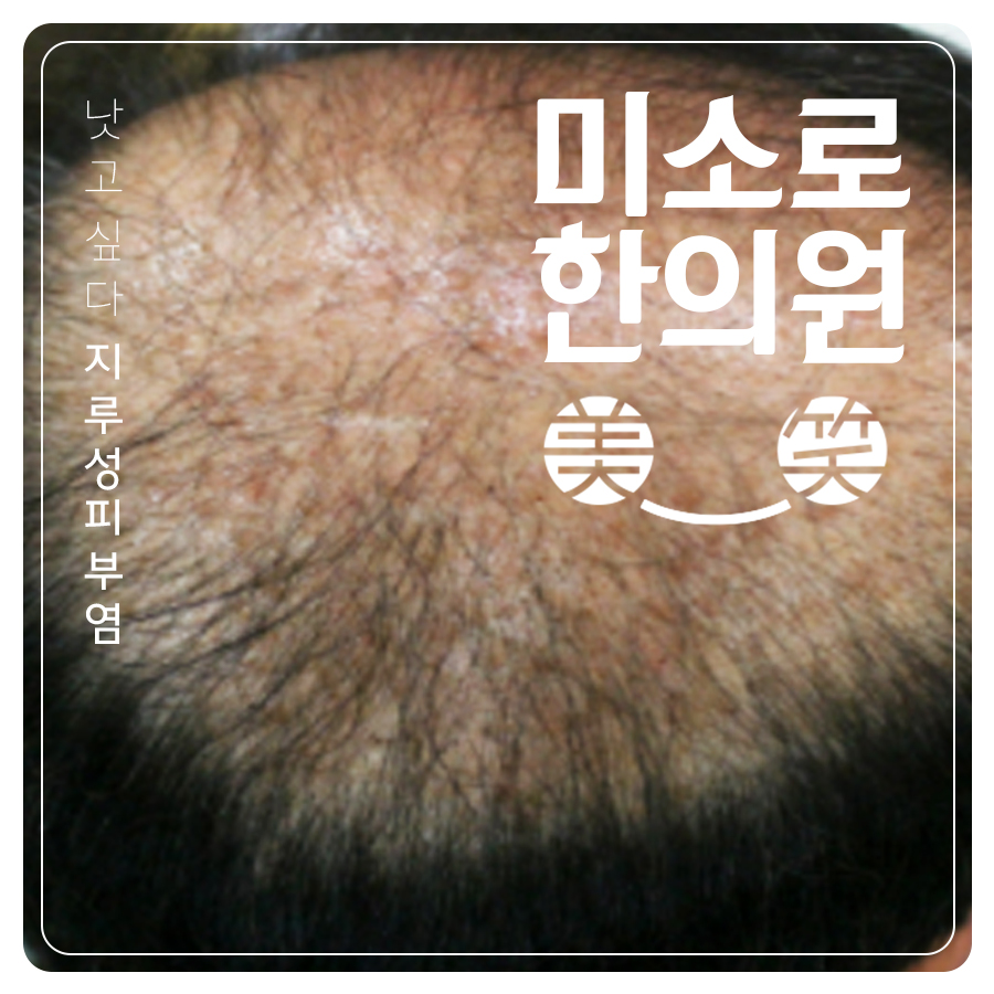 수내동 지루성 피부염 피부과 시술 관련 이미지