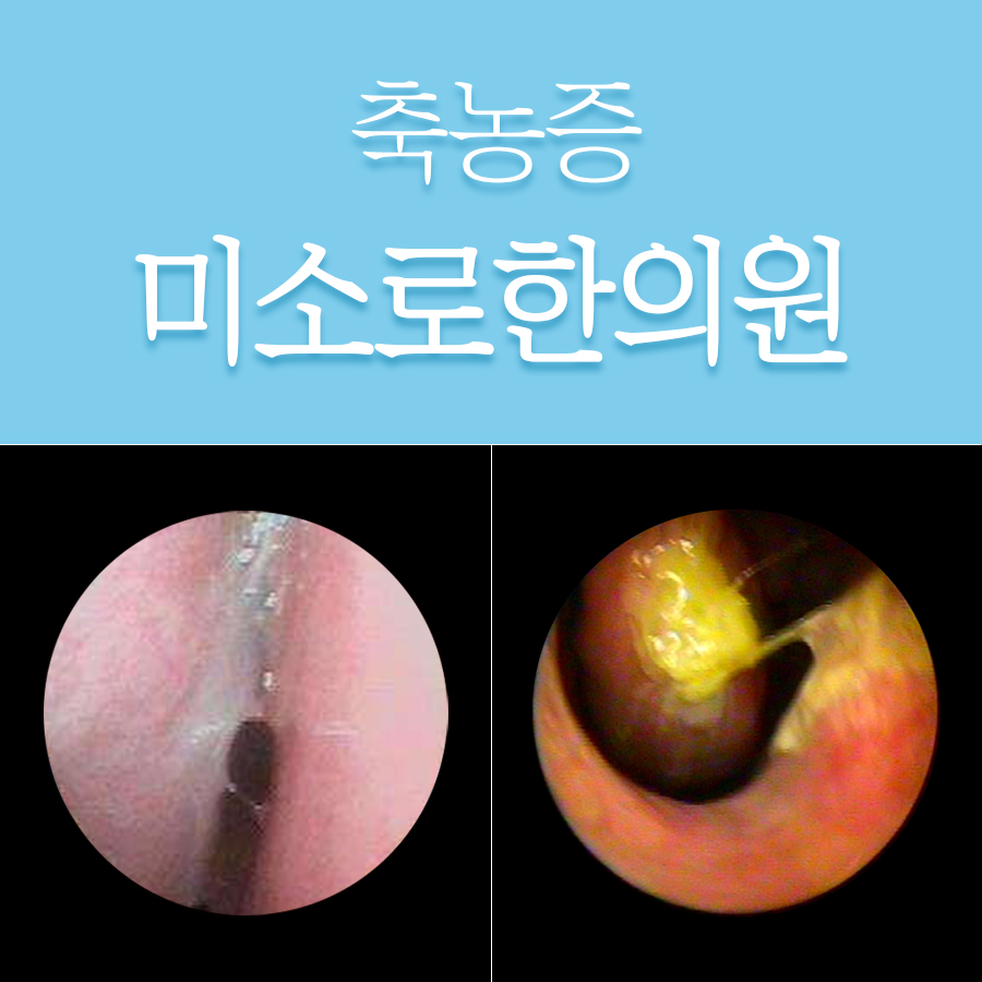 용인 축농증내시경수술비용 관련 이미지