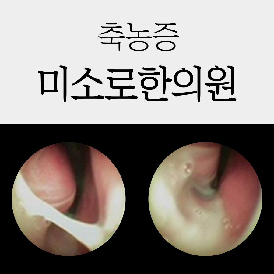 여주 만성 부비동염 완치 기간 관련 이미지