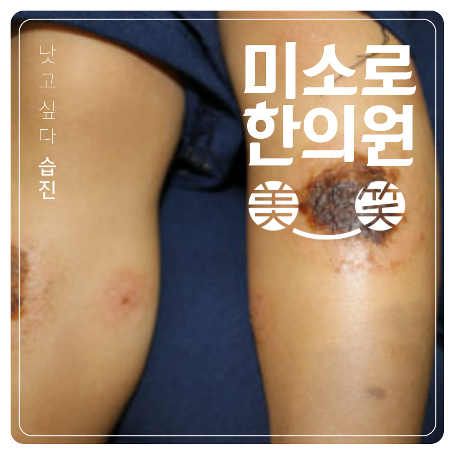 분당 남자 사타구니 습진 치료 관련 이미지