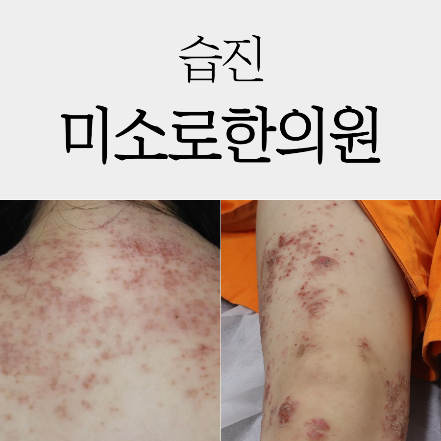 용인 화폐상습진 원인 관련 이미지