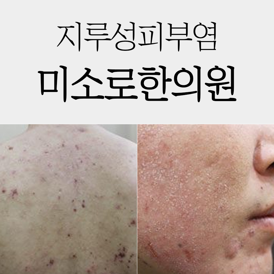두정동 지루성피부염한의원추천 관련 이미지