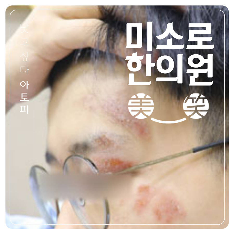 논산 아토피 한약 실비 관련 이미지