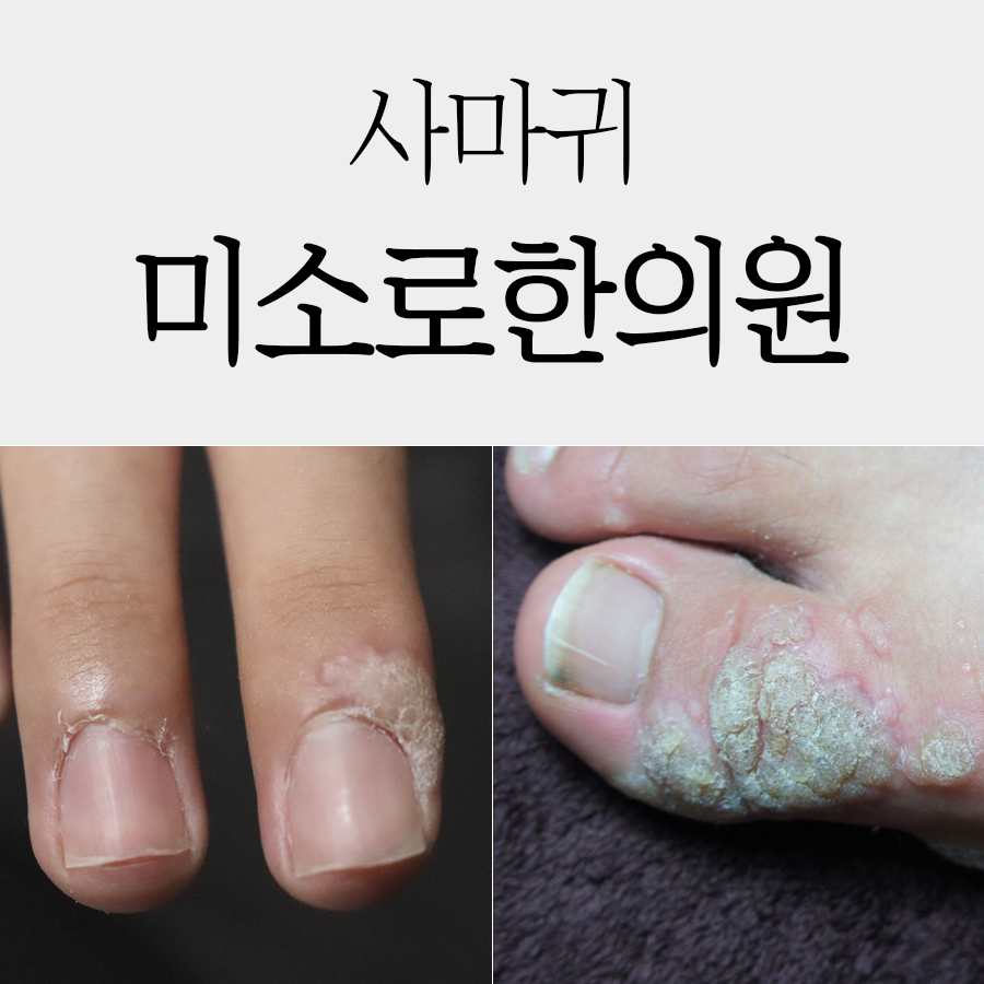 분당 사마귀 병원 관련 이미지