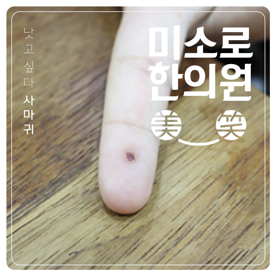 분당 얼굴 평편사마귀 레이저 관련 이미지