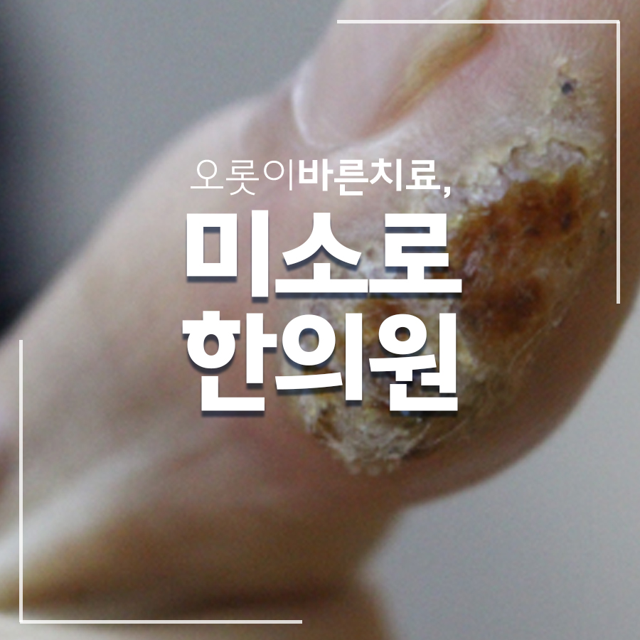 용인 몸 사마귀 관련 이미지