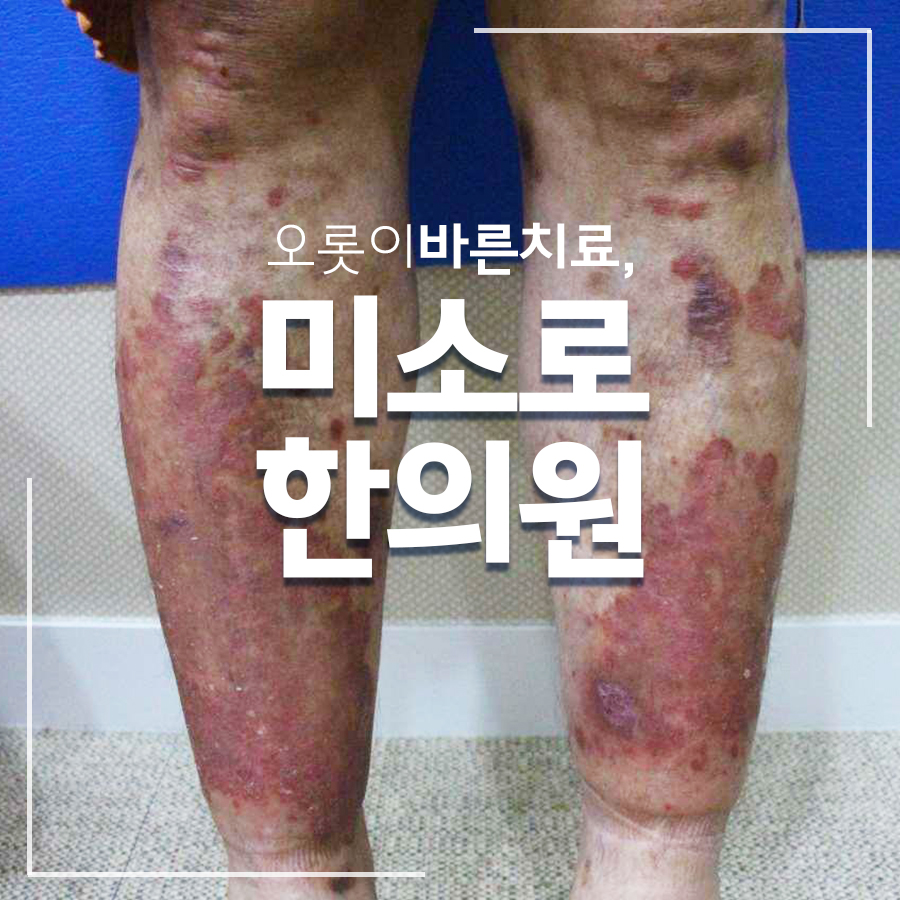 분당 건선피부치료 관련 이미지