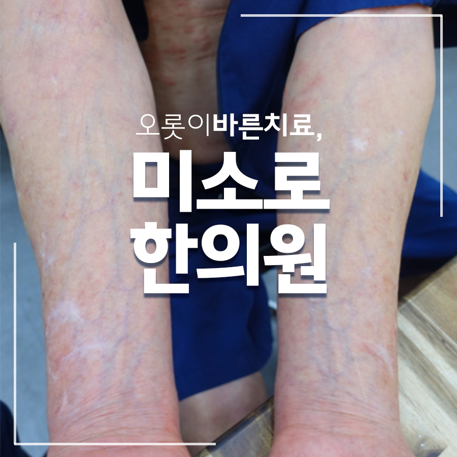 이천 피부묘기증 치료 관련 이미지