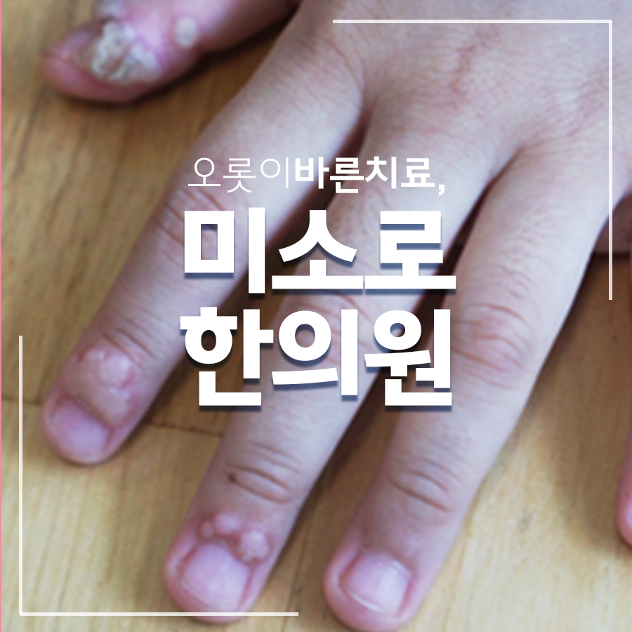 광명 편평사마귀 완치후기입니다 관련 이미지