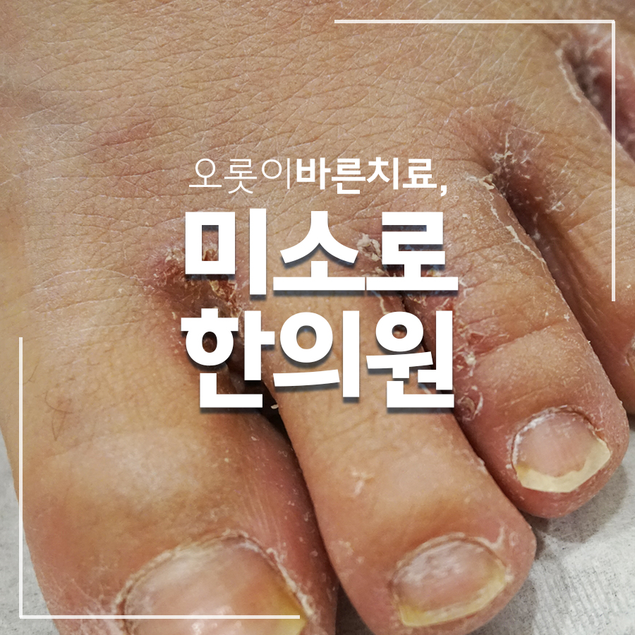 분당 한포진 한의원 실비 관련 이미지