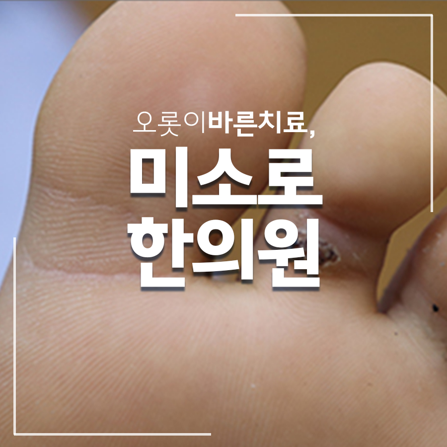분당 편평사마귀 재발 방지 관련 이미지