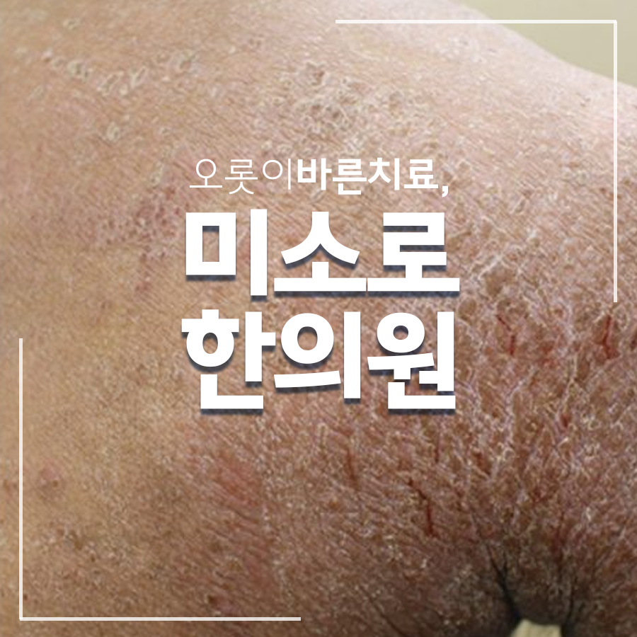 송도 유아 아토피 치료병원 관련 이미지