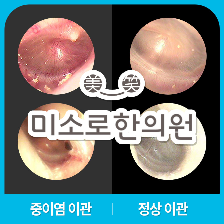 분당 중이염 병원 관련 이미지