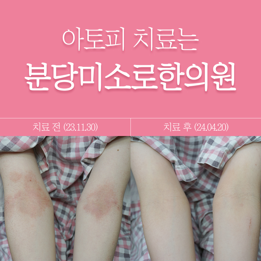 분당 아토피 한의원 관련 이미지
