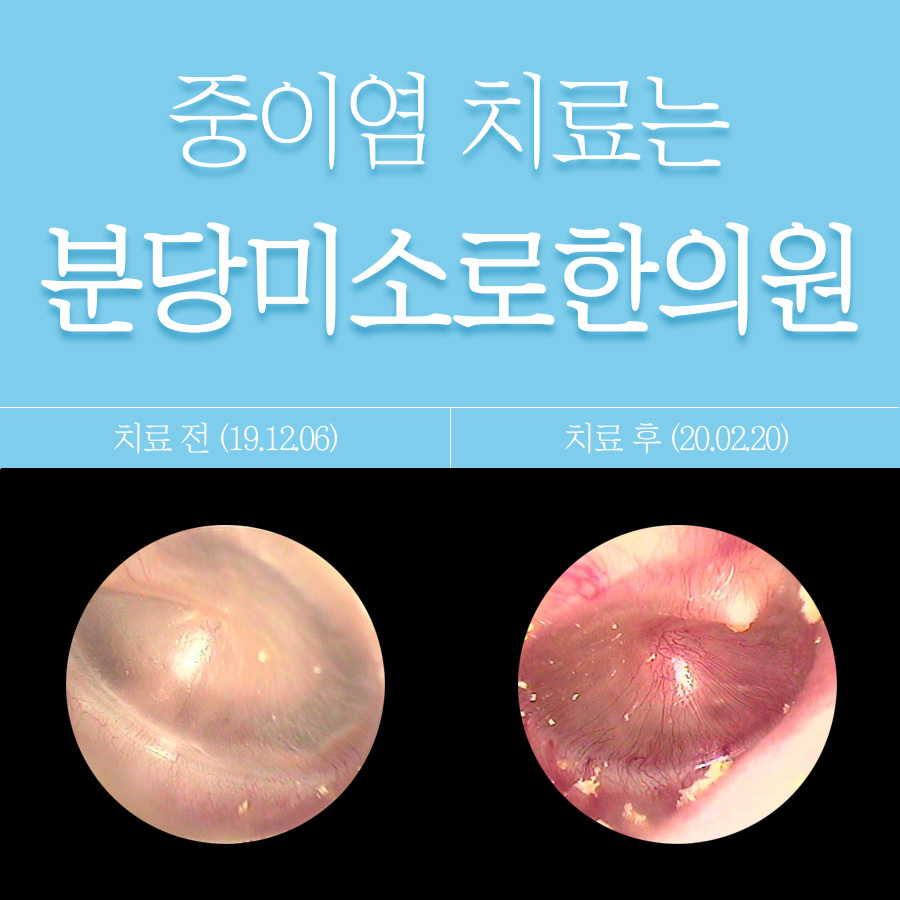 분당 중이염 이비인후과 관련 이미지