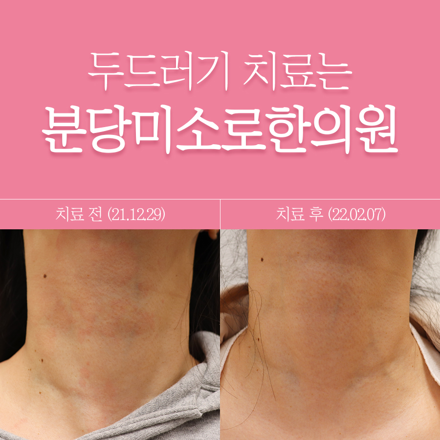 분당 두드러기 병원 관련 이미지