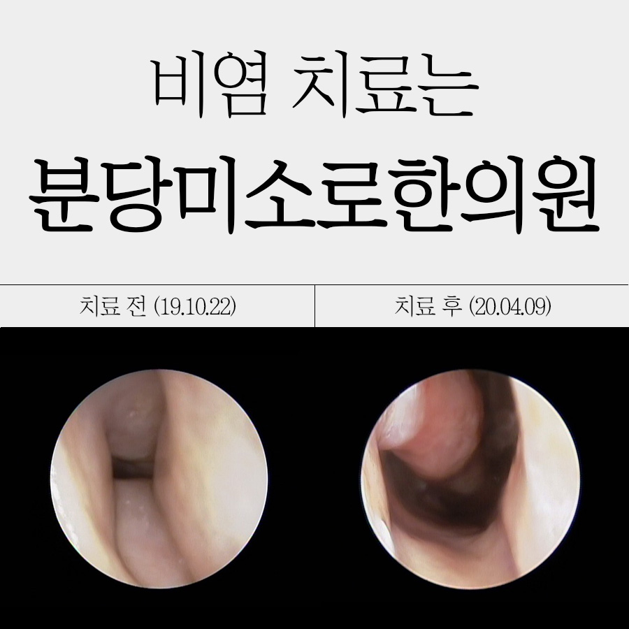 분당 알레르기 비염 치료제 관련 이미지
