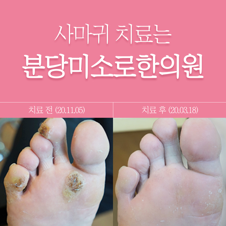 분당 목 사마귀 제거 후기 관련 이미지