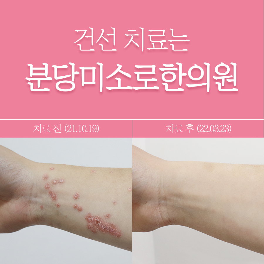 분당 건선피부치료 관련 이미지