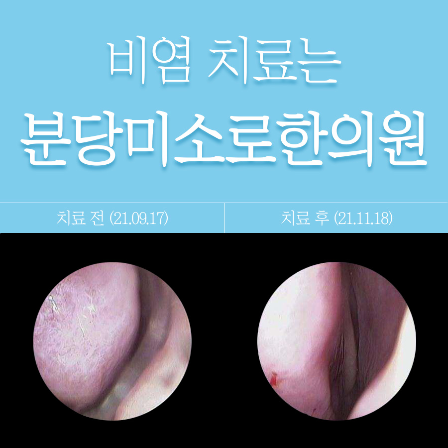 분당알레르기성비염한의원 관련 이미지