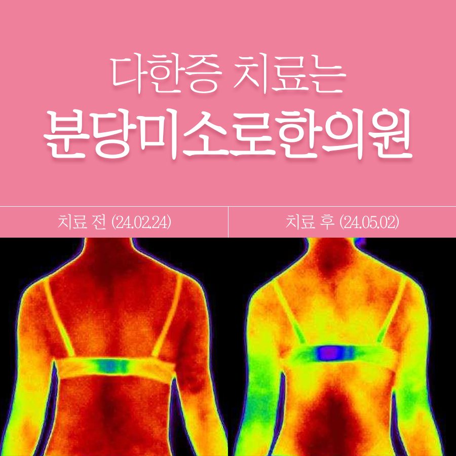 분당 다한증 치료 비용 관련 이미지