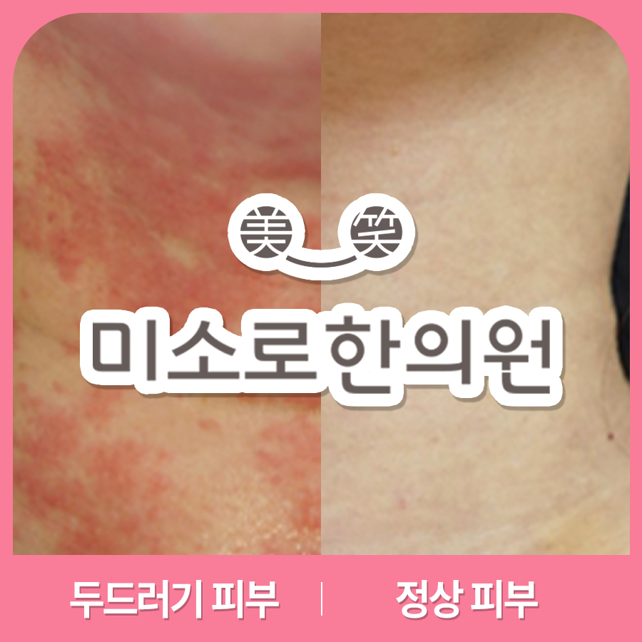 분당 알레르기 두드러기 병원 어디로 관련 이미지