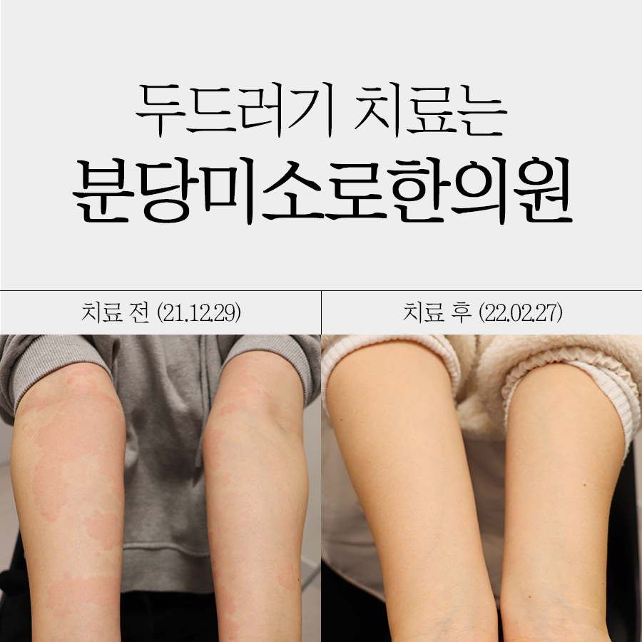 분당 콜린성 두드러기 한의원 관련 이미지