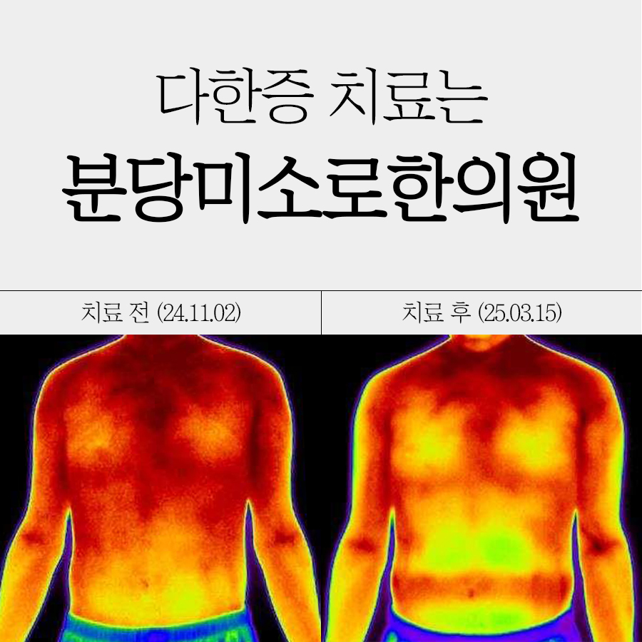 분당 다한증 치료 한의원 관련 이미지